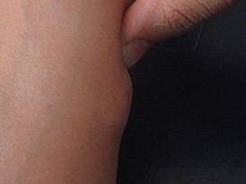 На мышце руки уплотнение. причины появления подкожных шишек на теле человека