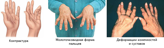 Артрит как заболевание-маркер остеопороза. виды артрита и симптомы. диагностика и препараты для лечения артрита