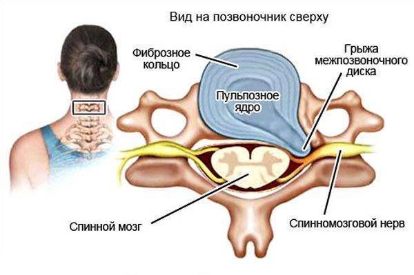 Упражнения бубновского при грыже грудного и шейного отдела позвоночника