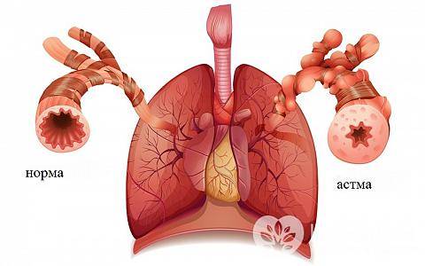 Основные проявления бронхиальной астмы: первые признаки и основные симптомы