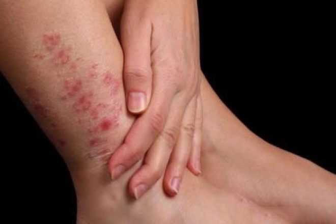 Нарушение пигментации кожи: причины появления пигментных пятен на теле