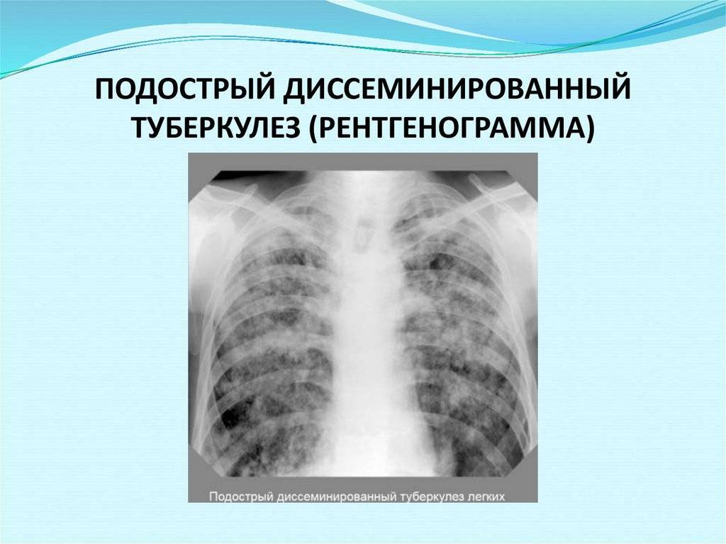 Рентгенологическая картина милиарного туберкулеза