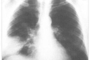 Кандидозная пневмония, или инвазивный кандидоз лёгких