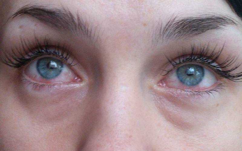 Причины красных глаз после наращивания ресниц, что в этом случае делать?