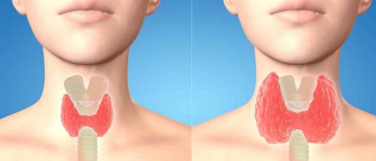 Причины и лечебные меры при диффузном и узловом нетоксическом зобе щитовидки