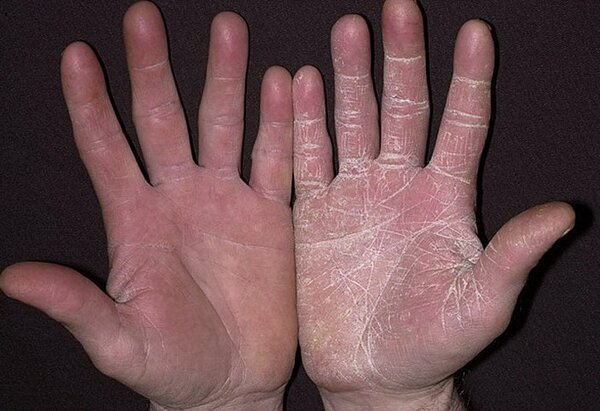 Грибок ногтей на руках: причины возникновения, симптоматика, традиционное и альтернативное лечение