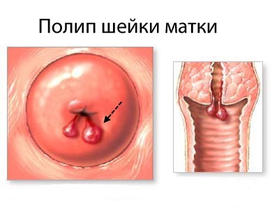 Полип шейки матки: симптомы и лечение, фото, операция по удалению