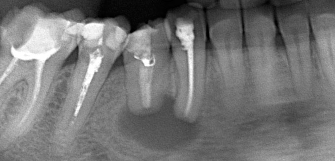 Киста зуба: причины, симптомы, консервативное и домашнее лечение