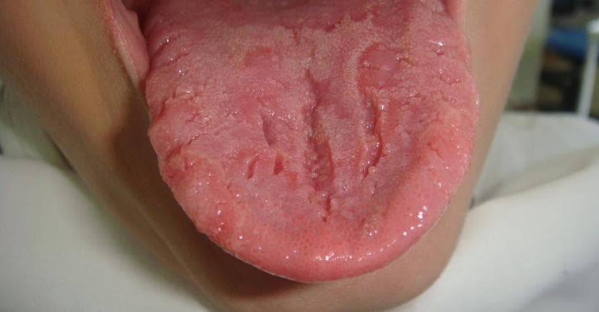 Воспаление сосочков на корне и кончике языка, причины увеличения (гипертрофии)