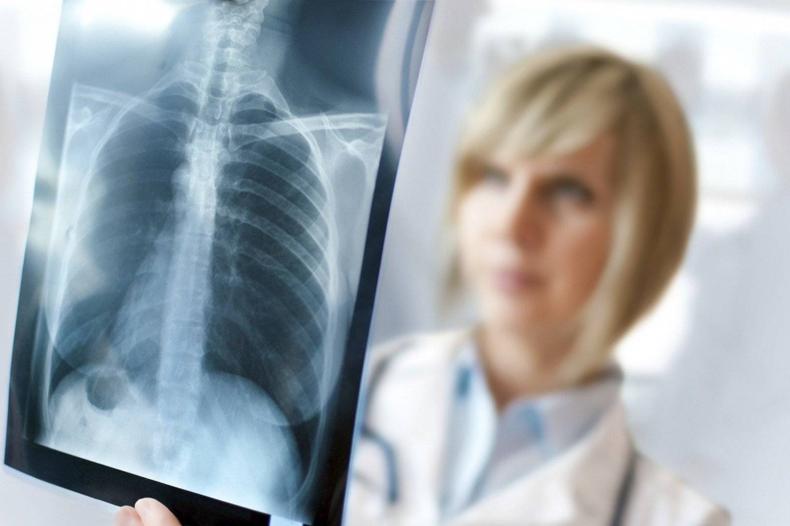 Рентген при туберкулезе: зачем проводить, показания, признаки