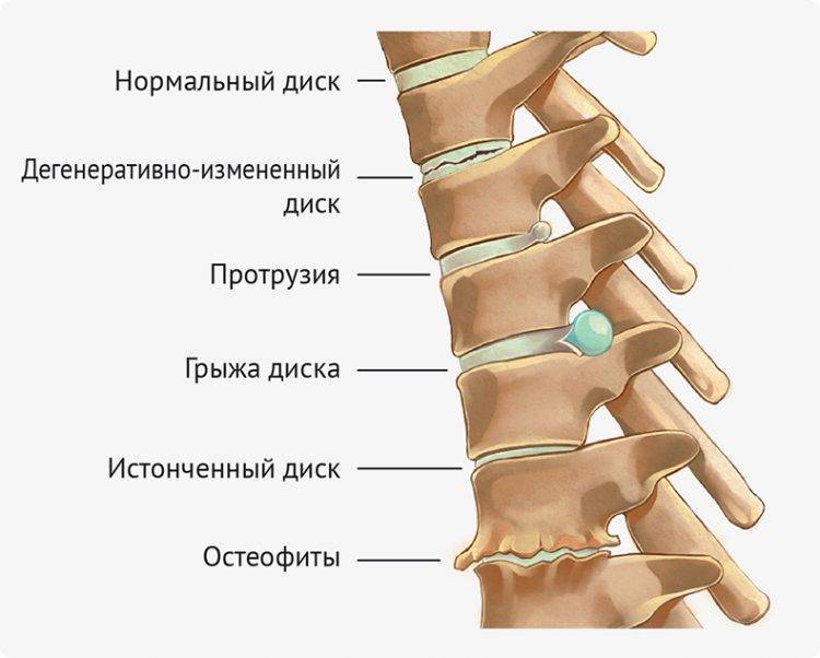 Хондроз поясничного отдела позвоночника симптомы лечение лекарство