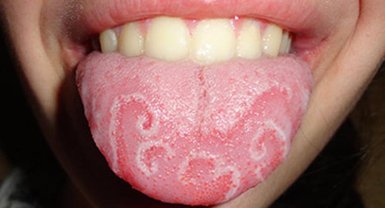 Стоматит — фото, как выглядит во рту, признаки