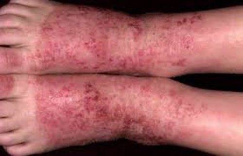 Как избавиться от дерматита на ногах