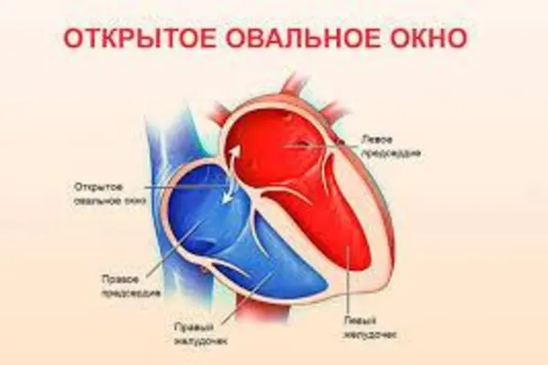 Открыто овальное окно у новорожденного - открытое овальное окно в сердце у ребенка - запись пользователя инна (batinka) в сообществе здоровье новорожденных в категории болезни сердца - babyblog.ru