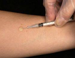 Прививка манту: побочные эффекты и противопоказания