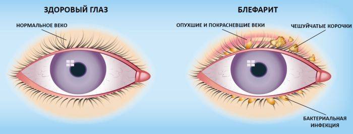 Глазные капли с гиалуроновой кислотой