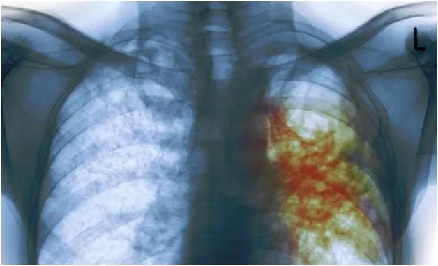 Скрытая форма туберкулеза: лечение и профилактика
