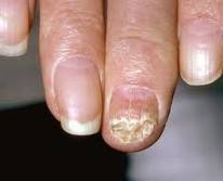 Симптомы и лечение онихомикоза ногтей на руках и ногах: недорогие, эффективные препараты
