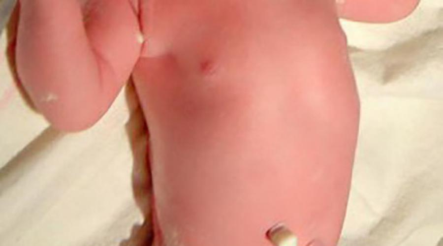 Почему может кровить пупок у новорожденного и что с этим делать?