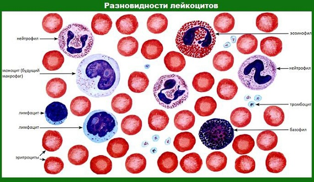 Лейкоциты повышены в крови (лейкоцитоз): нормы, причины