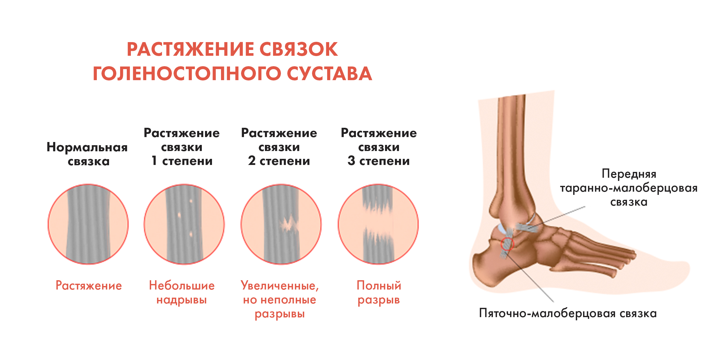Разрыв связок коленного сустава: причины, симптомы, лечение