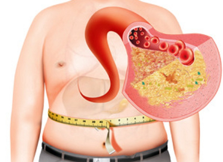 Народные средства от жирового гепатоза печени: методы лечения и противопоказания