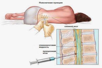 Миелит (воспаление) спинного мозга. миелит