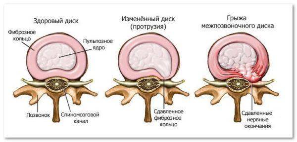 Карипазим при грыже позвоночника отзывы цены