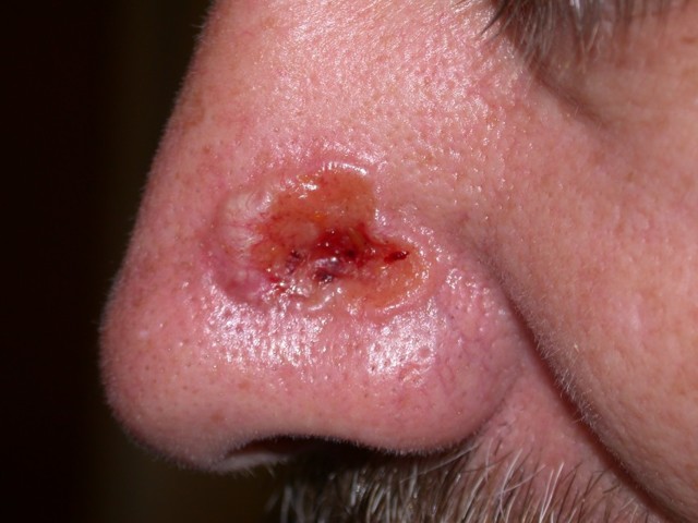 Базалиома носа: фото кожи на носу, лечение, удаление