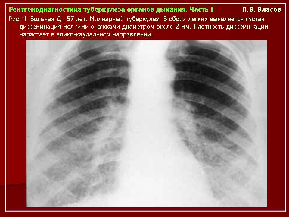 Рентгенологическая картина милиарного туберкулеза