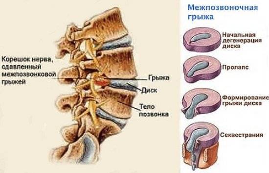 Карипазим при грыже позвоночника отзывы цены