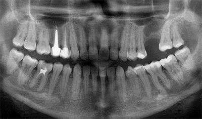 Способы удаления и лечения антибиотиками гранулемы зуба