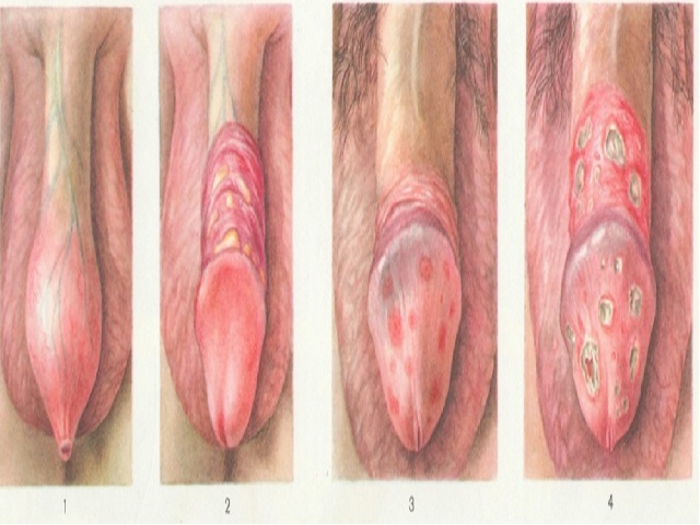 Фимоз (неполный, патологический) у мужчин: как выглядит, лечение