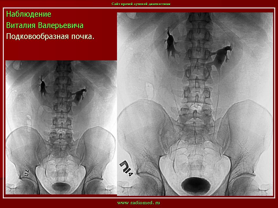 Подковообразная почка у ребенка чем опасна