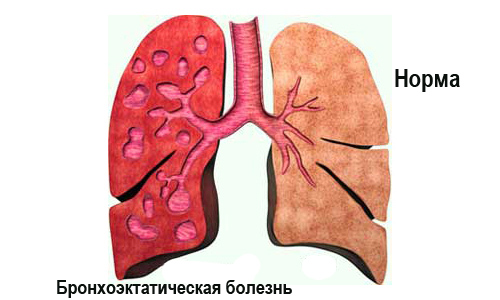Коделак бронхо с чабрецом (codelac broncho with thymus serpyllum) инструкция по применению