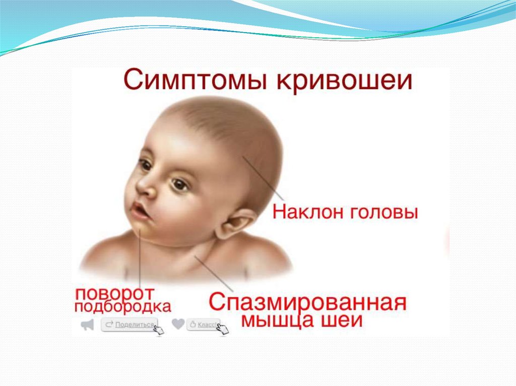 Признаки кривошеи - кривошея у ребенка 2 месяца фото - запись пользователя анастасия (nastalgiya) в сообществе здоровье новорожденных в категории кривошея - babyblog.ru