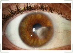 Что такое бельмо и катаракта? существуют ли в настоящее время способы лечения этих заболеваний?