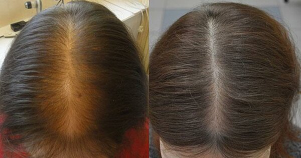 Миноксидил для волос: как действует, эффективность, фото до и после, отзывы. как применять женщинам и мужчинам, побочные эффекты, возможный вред. цена и отзывы