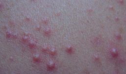 Токсико аллергический дерматит сколько лечится