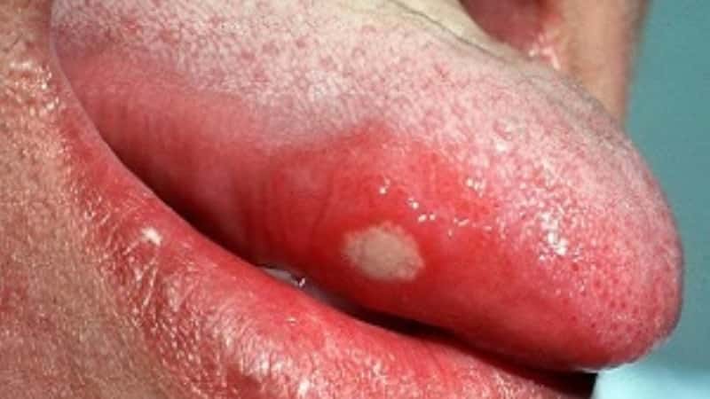 Стоматит — фото, как выглядит во рту, признаки
