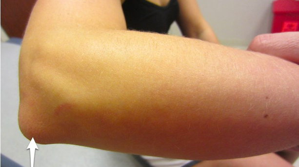 Что такое гнойный бурсит коленного и локтевого сустава: причины, симптомы и лечение