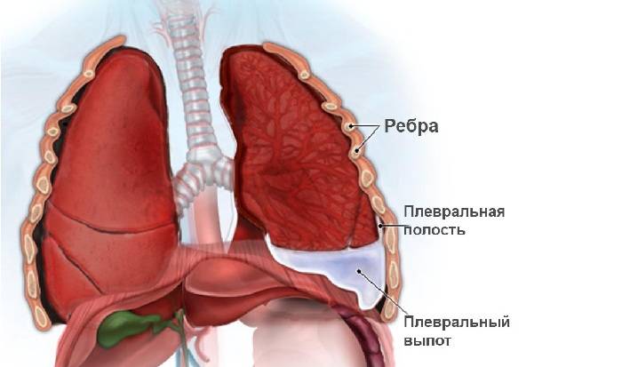 Стадии крупозной пневмонии: как развивается заболевание