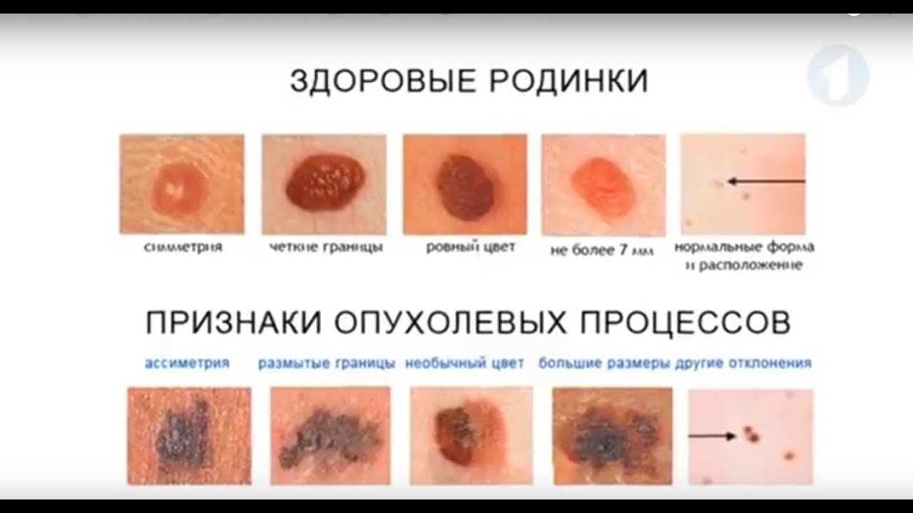 Как выглядит начальная стадия меланомы кожи: фото разных видов