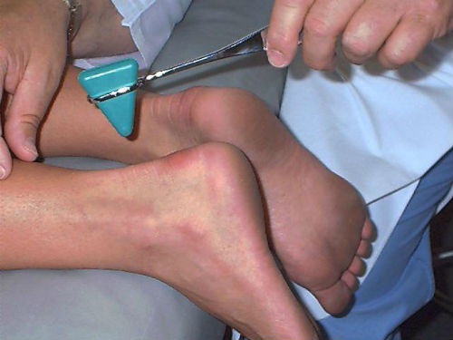 Болезнь шарко-мари-тута: наследственное заболевание