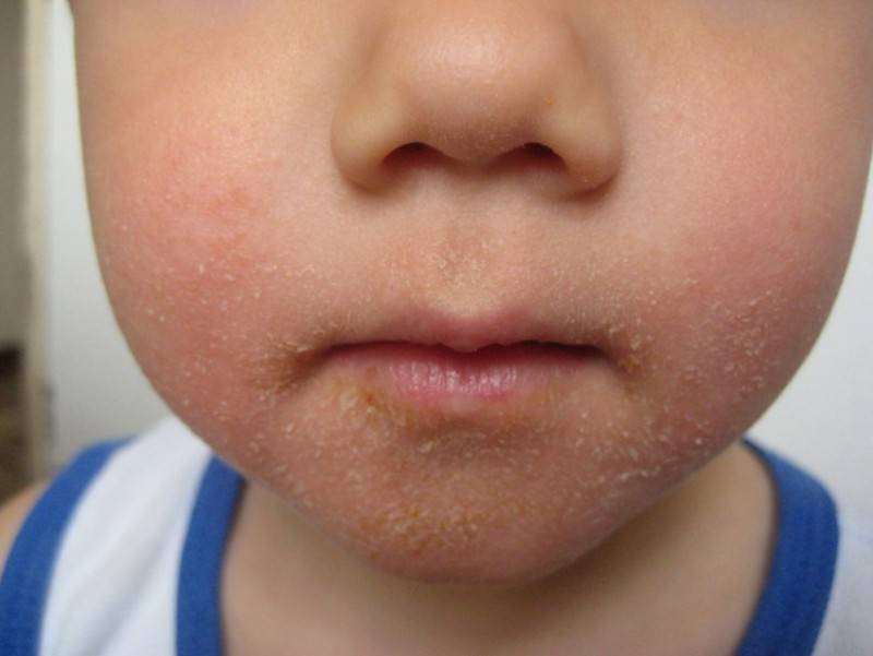 Аллергические прыщи на лице: причины, лечение, как быстро избавиться от аллергии в виде прыщей