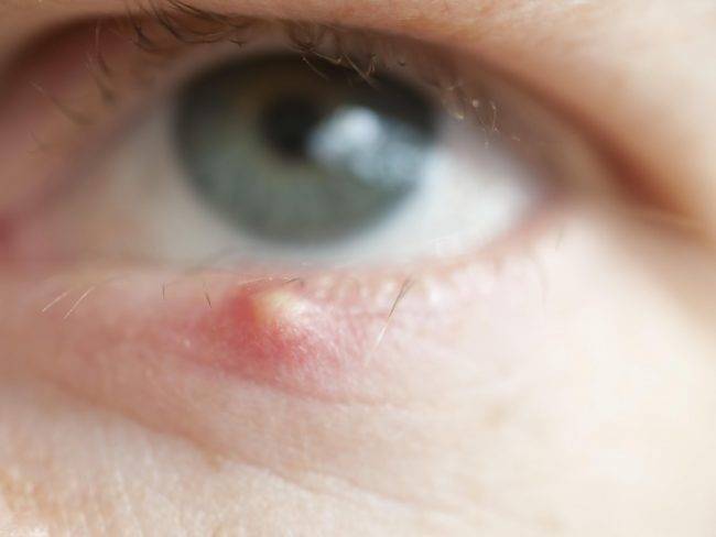 Доктор комаровский о том, как лечить ячмень на глазу у ребенка