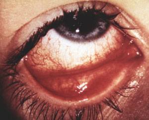 Хориоретинит глаза: что это такое, виды (центральный серозный, токсоплазмозный, туберкулезный, сифилитический, острый, очаговый), причины, симптомы, лечение, диагностика, осложнения, берут ли в армию