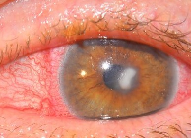 Кератит глаз — симптомы и лечение