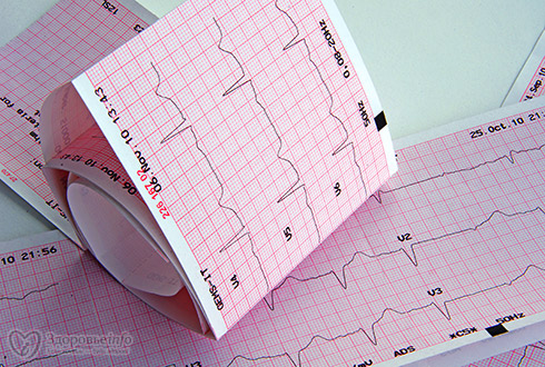 Признаки грядущего инфаркта можно узнать по лицу
