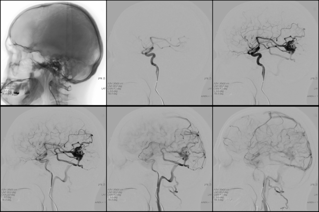 Ангиома головного мозга: особенности, осложнения и лечение